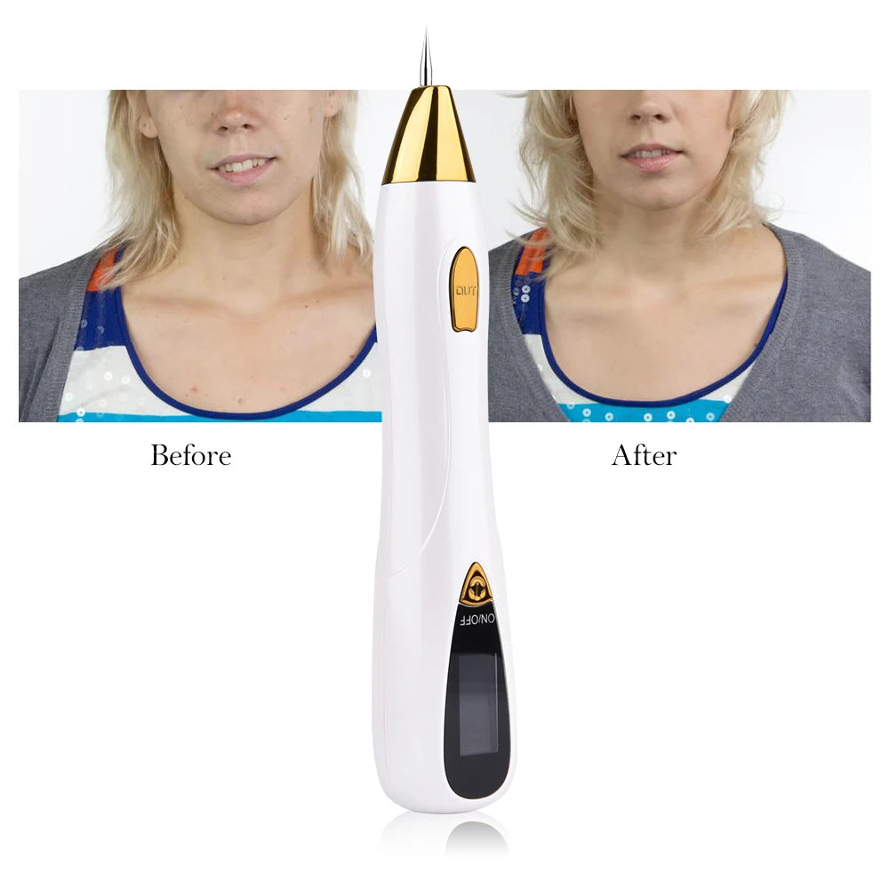 Stylo Laser Esthétique – Élimination des Taches, Grains de Beauté et Tatouages